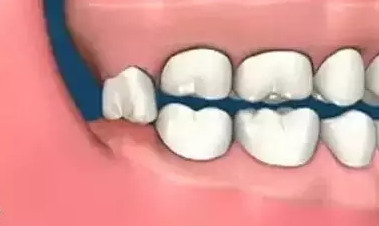 如果智齿对面没有对咬的牙齿,会发生智齿萌发过度,伸长的现象